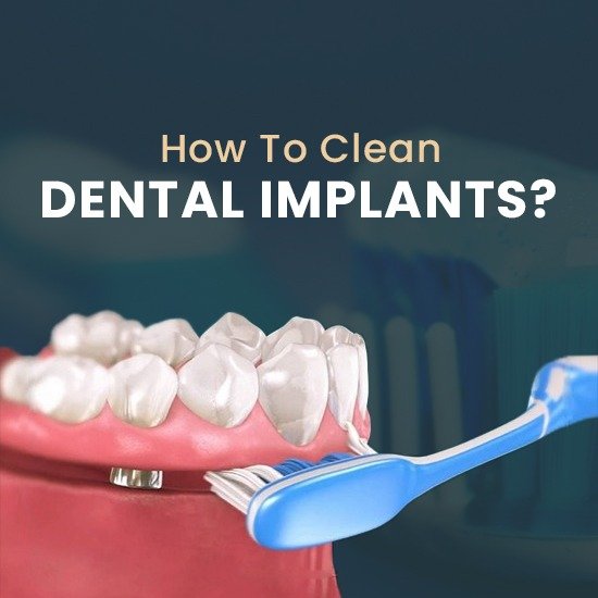 how-to-clean-all-on-6-dental-implant-placements